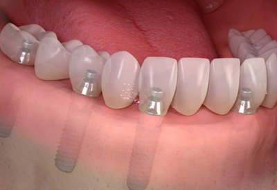 Dental-Implants
