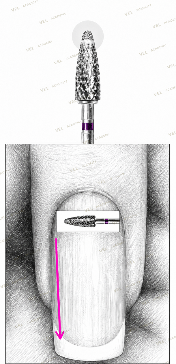 Deep lifting disrupted nail plate layers requiring 180 grit file