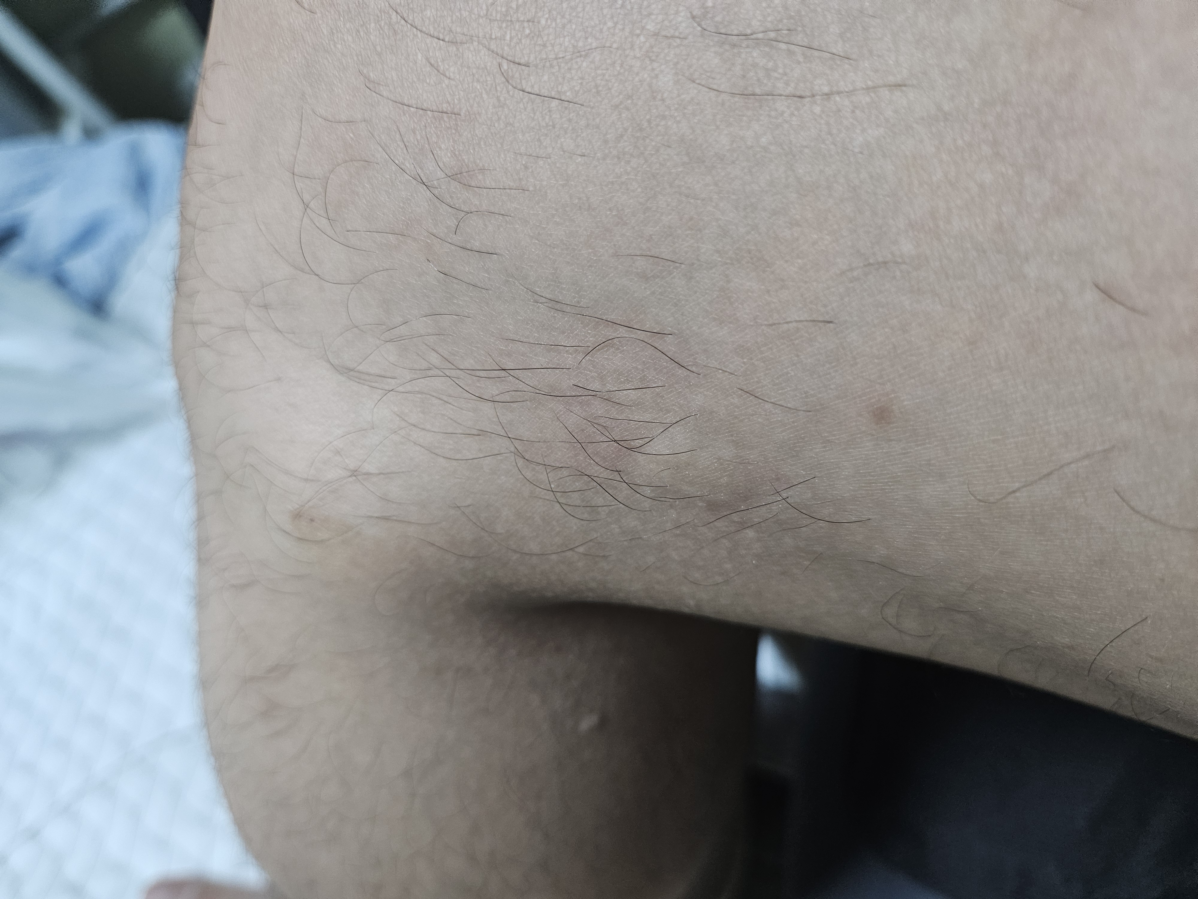 모기 독 제거기 사용 5분 후 가려움 완화 결과