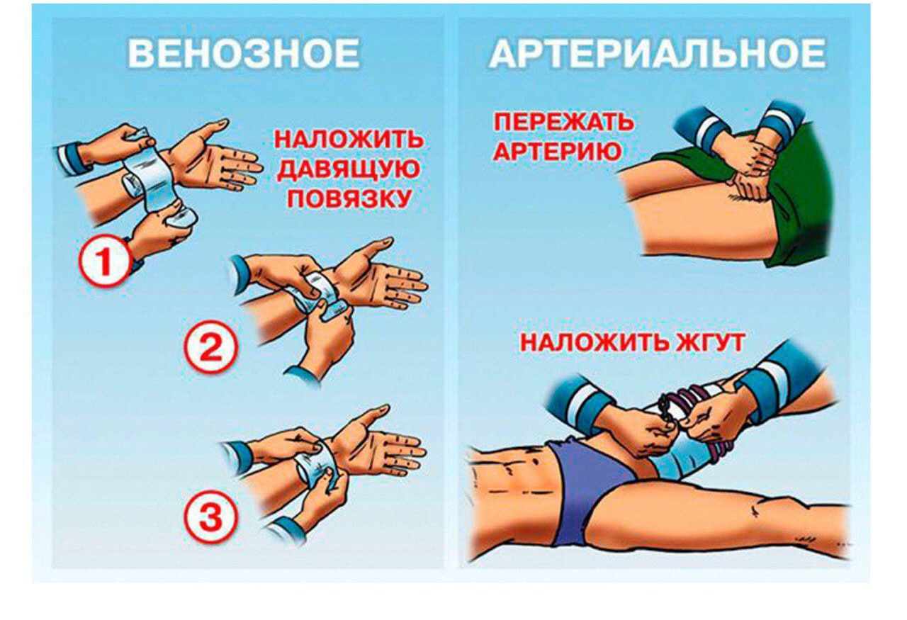 Остановка кровотечений