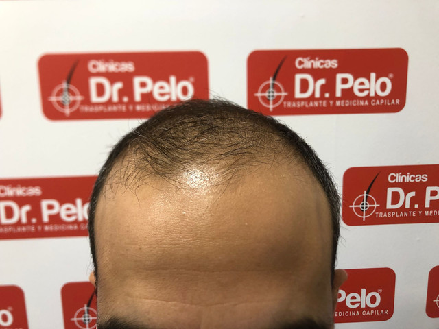 preop2