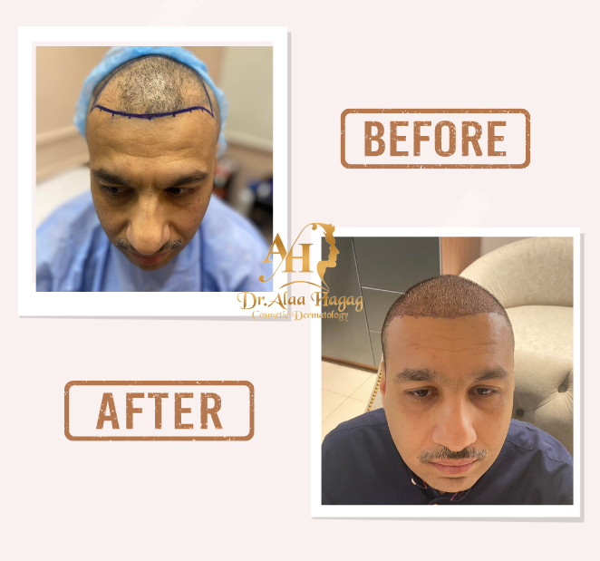 صورة قبل وبعد زراعة الشعر لمريض بعد ظهور النتيجة الطبيعية