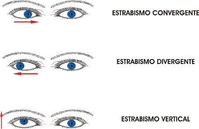 estrabismo.jpg