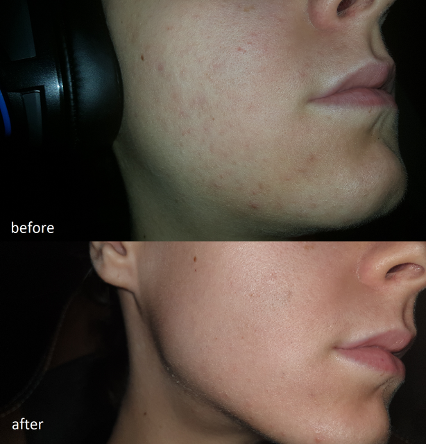 R-before-after