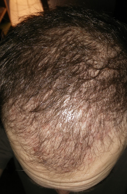 3rd-month-POST-OP