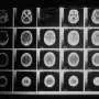 Childhood Brain Tumor Treatment: Targeting Energy Production