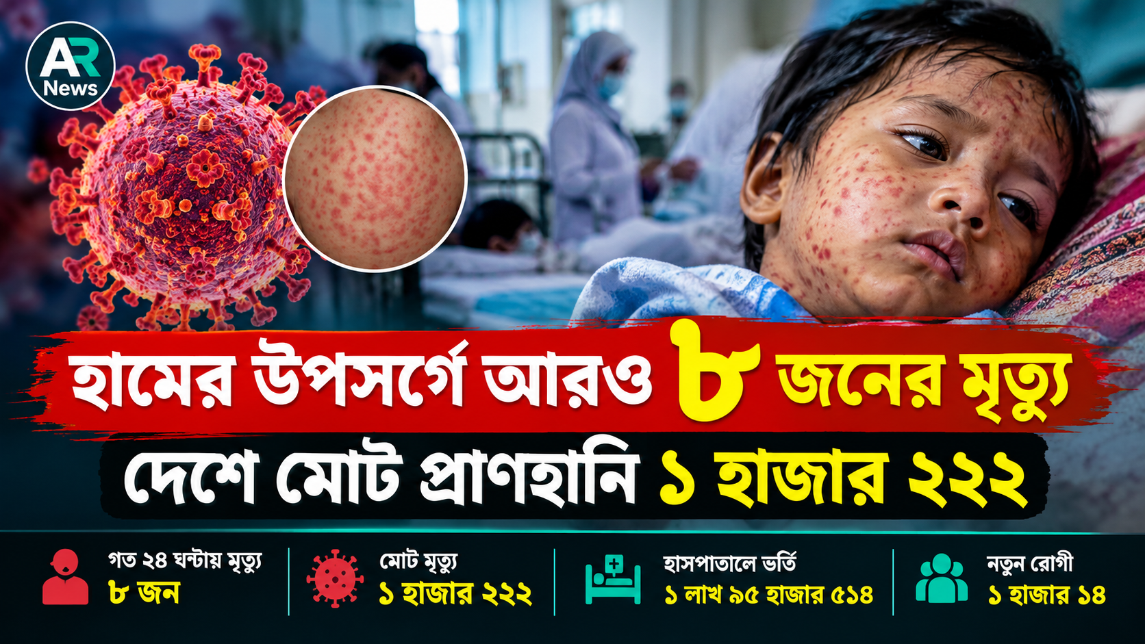 হামের উপসর্গে আরও ৮ জনের মৃত্যু, দেশে মোট প্রাণহানি ১ হাজার ২২২