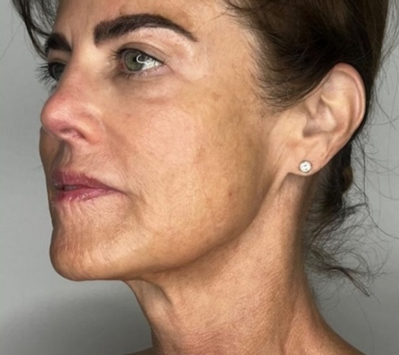 After Sofwave treatment at Let's Face It Med Spa