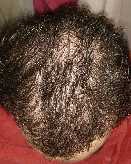 5th-month-POST-OP