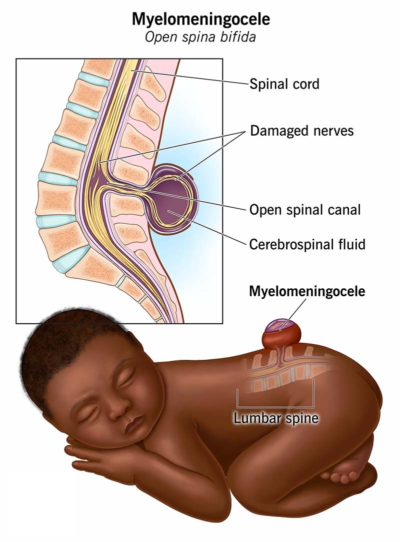 Myelomeningocele open spina bifida