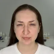 Межбровье после
