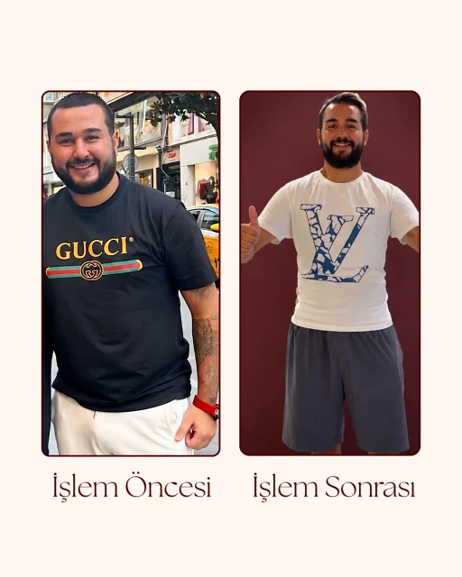 G5 Öncesi Sonrası 9