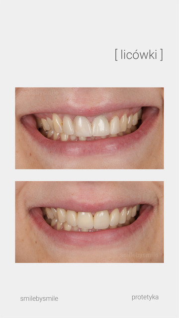 Licówki przed i po #7 – Smile by Smile Wrocław