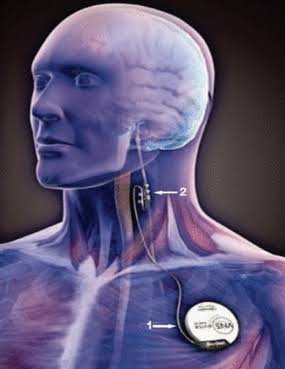 Vagus nerve stimulator VNS device
