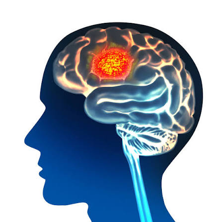 Glioma MRI