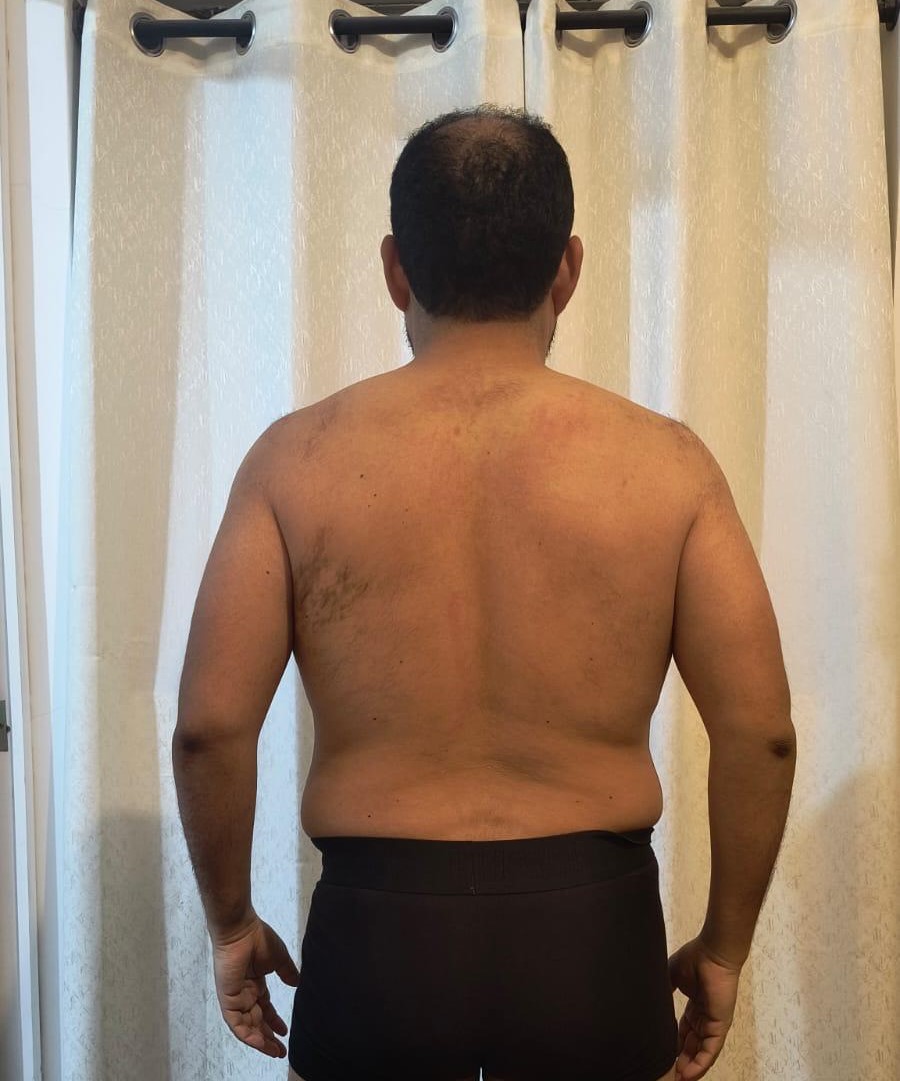 Caso de recomposición corporal - antes y después - antes