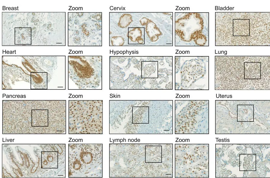 New Mechanism Behind Breast Cancer Spread Uncovered