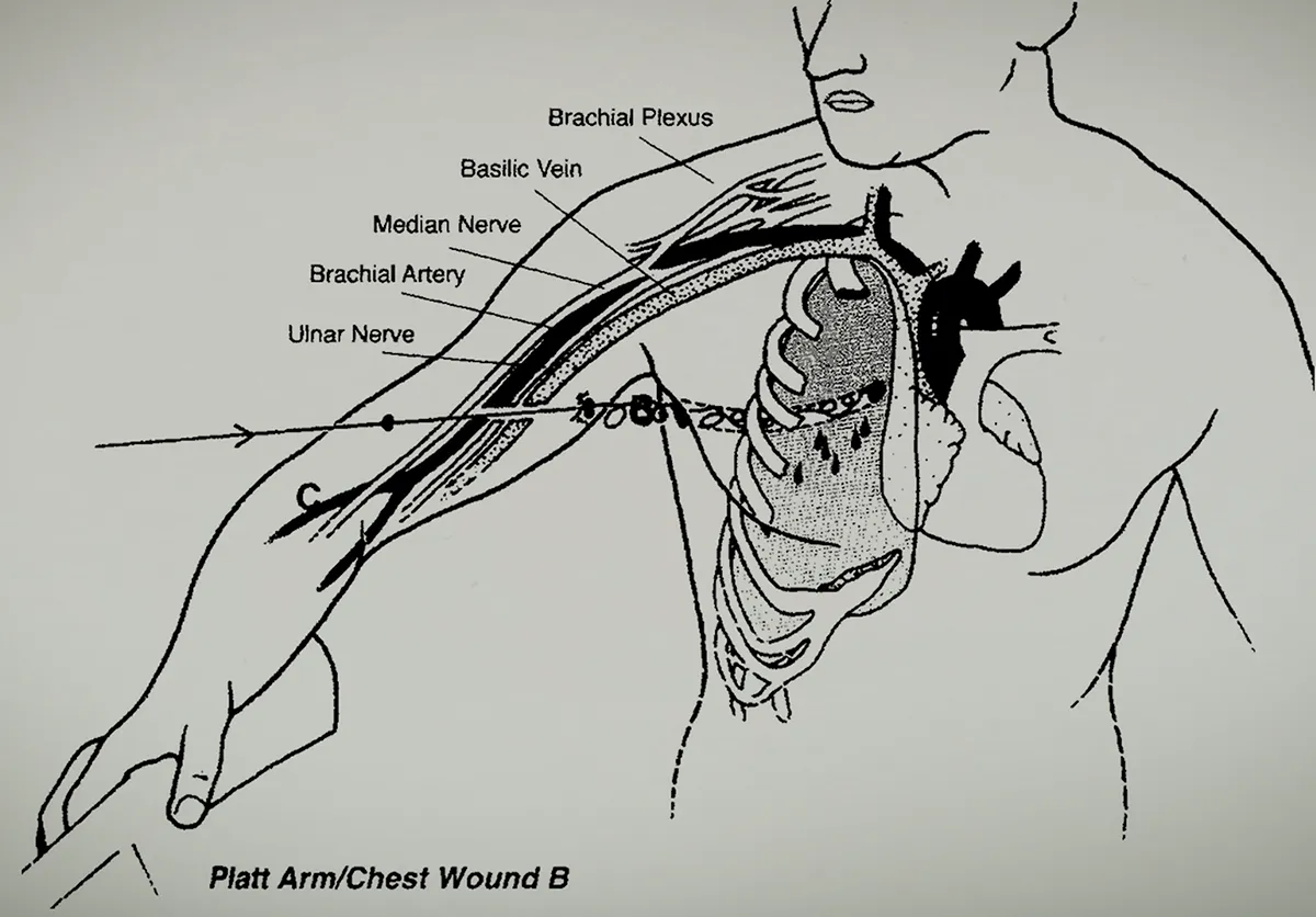 [Resim: platt-wound-1.webp]