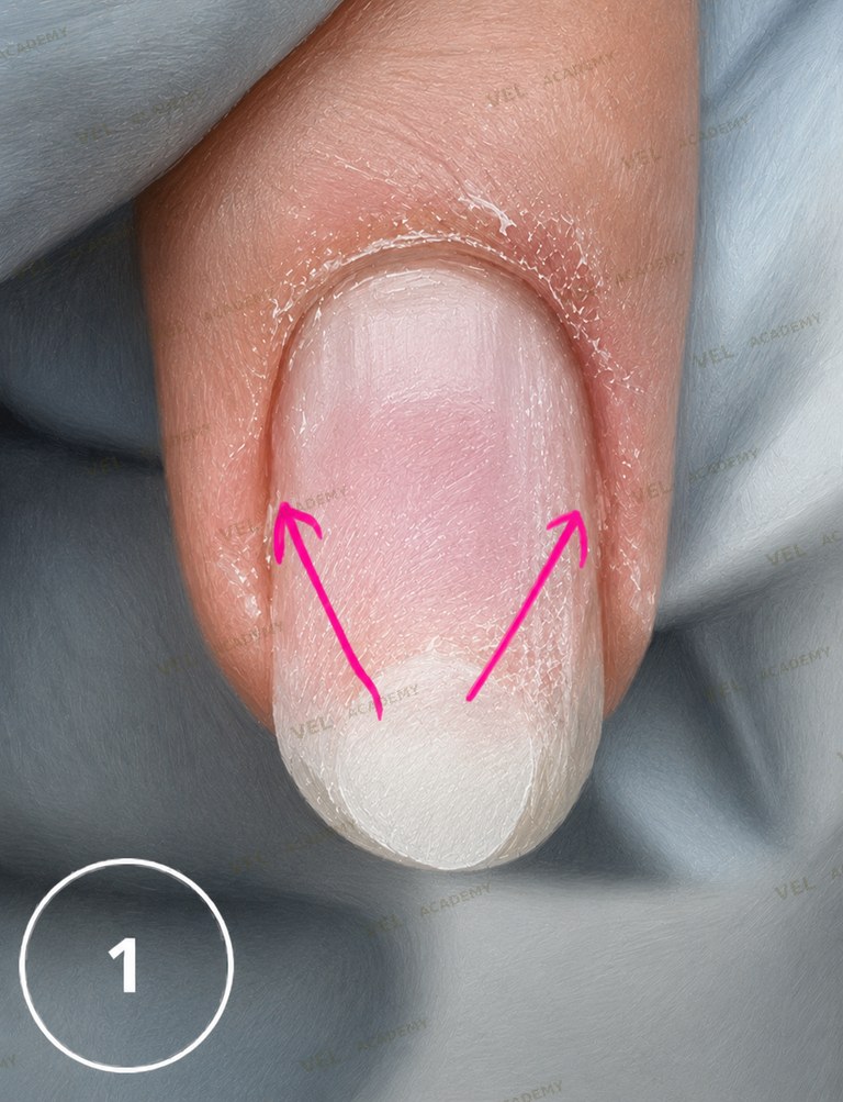 PolyGel architecture restoration step 1 distributing thin layer toward growth points