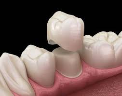 Corona dental