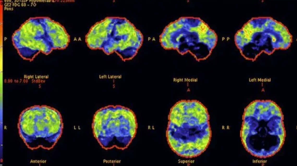 PET scan before treatment