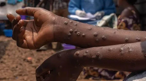 Illustration - Mpox : 1153 cas en six semaines dans 11 pays africains, Madagascar reste l'epicentre mondial