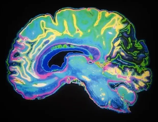 Sleep Deprivation Alters Brain Connections