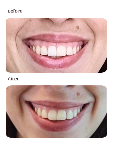 Sorriso Gengival
