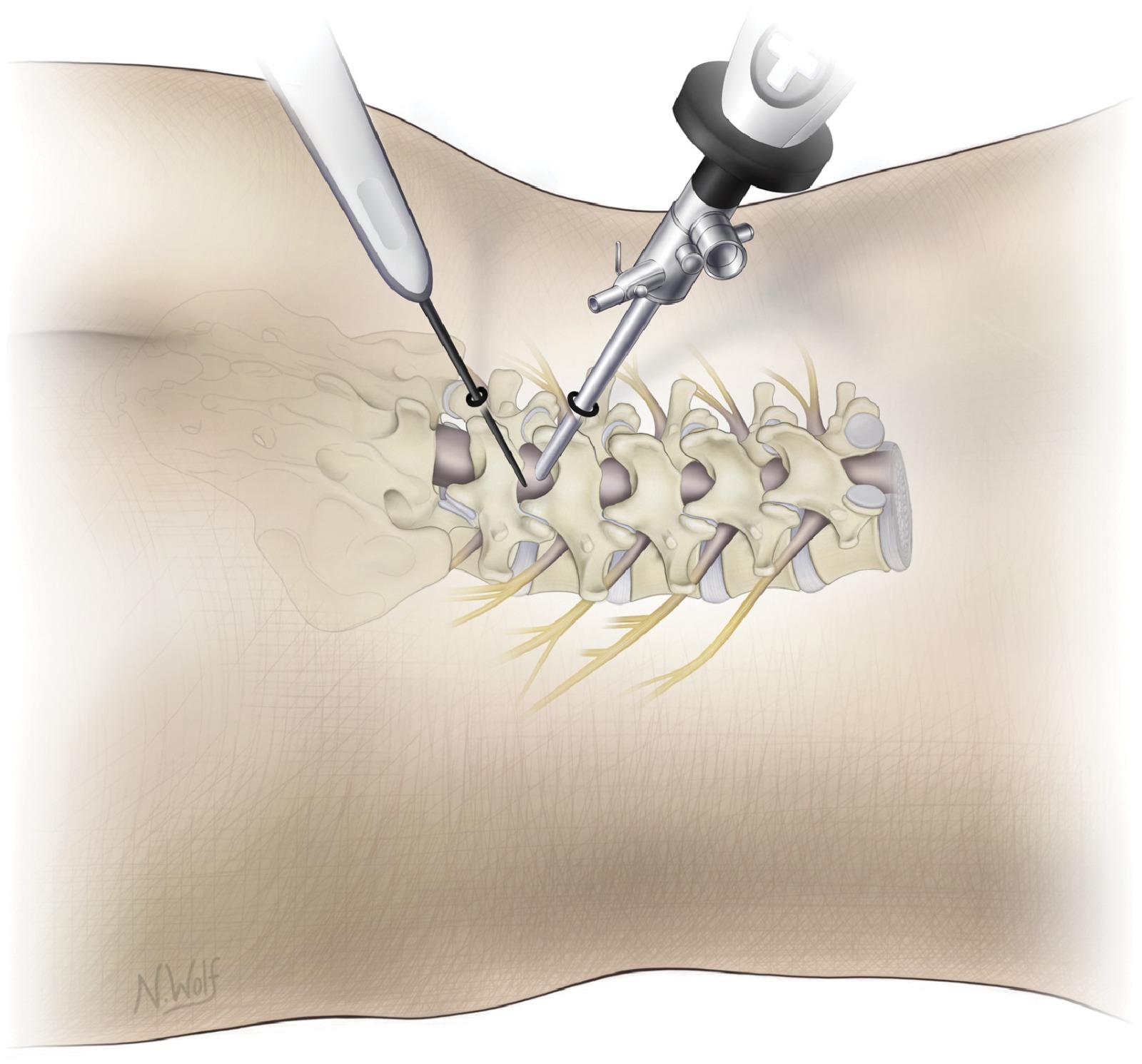 Biportal endoscopic spine surgery UBE