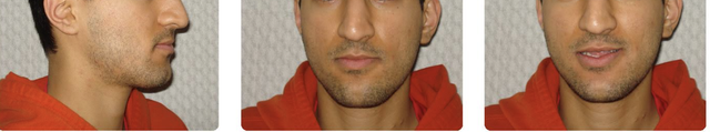left-right-discrepancy-long-face