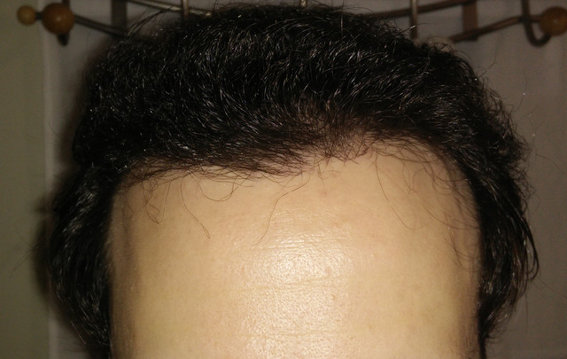 7th-month-POST-OP2