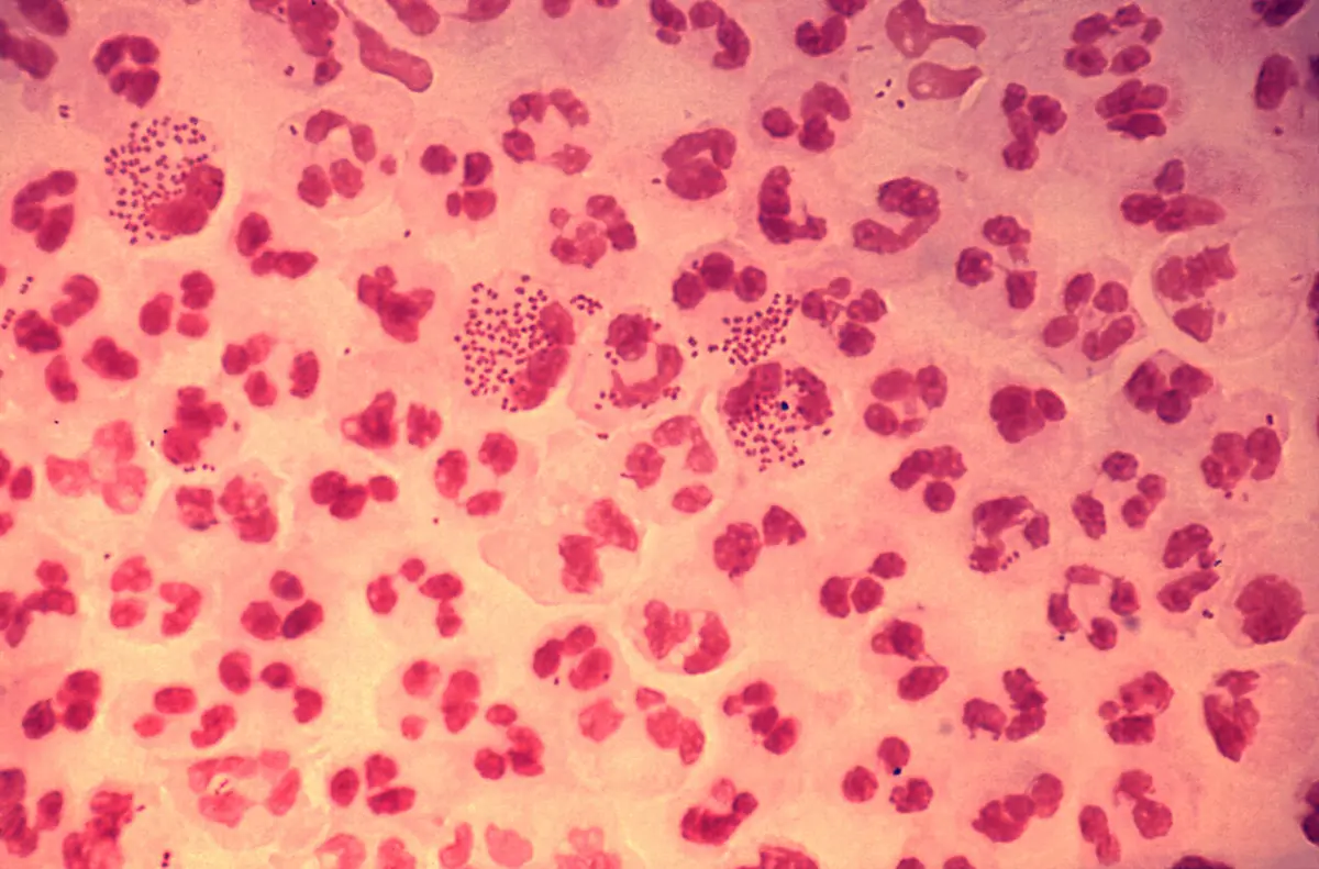 New Therapies and Tests to Combat Drug-Resistant Gonorrhea