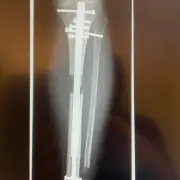 TIBIAS & FEMURS with Dr. Becker & Dr. Betz – FULL JOURNEY (8+5=13 CM)