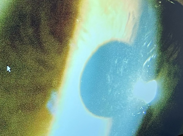 eye
