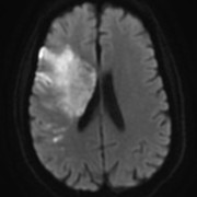 STROKE MRI 5