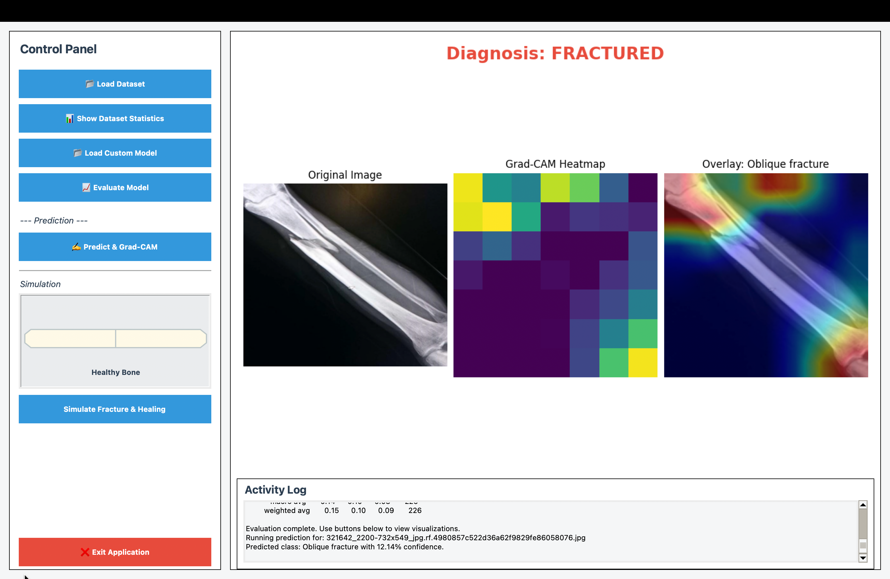FractureAI Revolutionizing Bone Fracture Detection with Deep Learning CNNs for Precision Medical Imaging