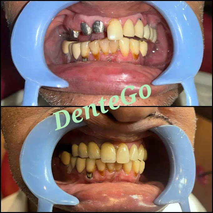 Dental Restoration at DenteGo