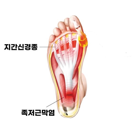 발바닥 앞쪽 통증의 원인 분석