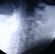 Image 3 - Hypogastric Plexus