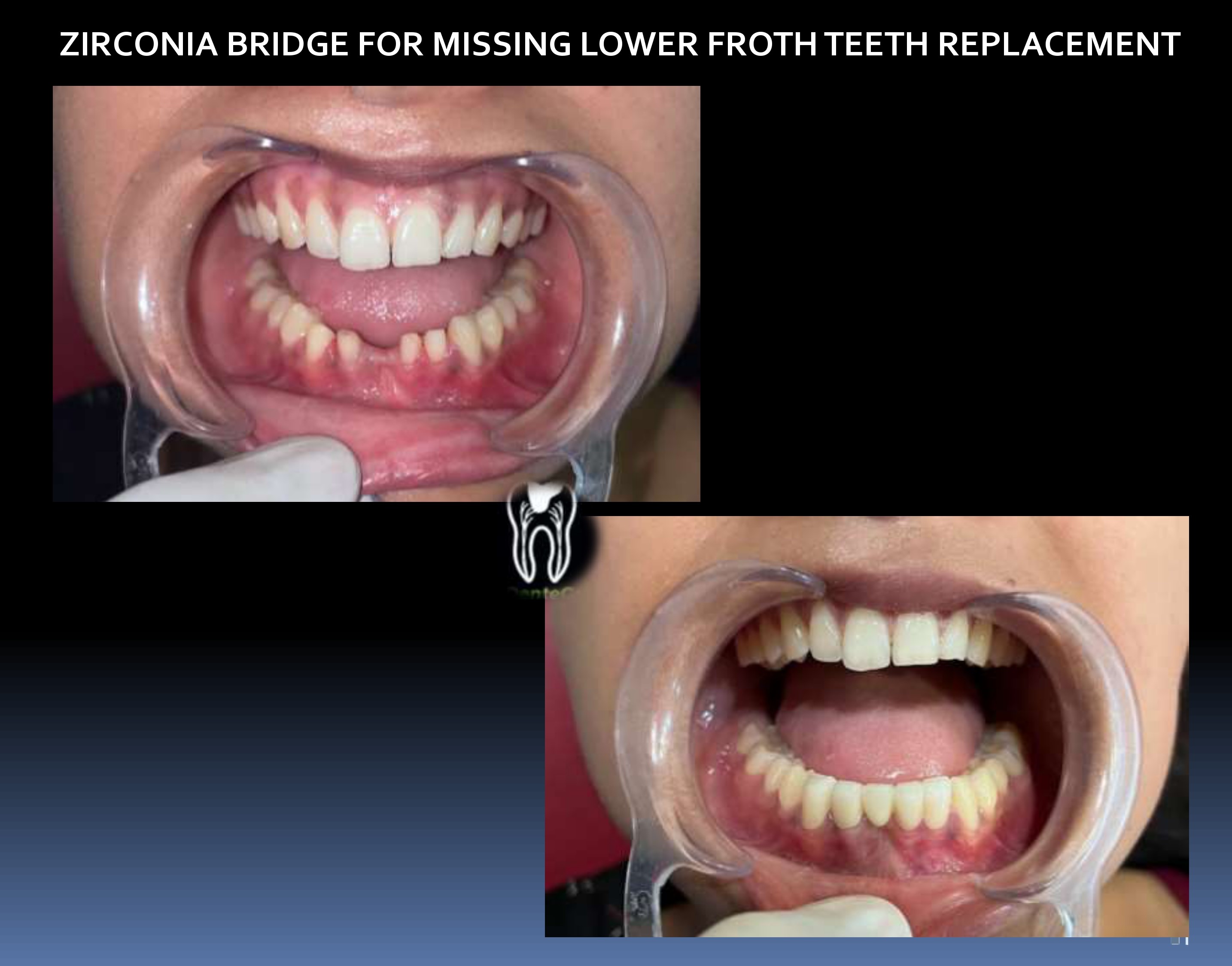 Lower Zirconia Bridge