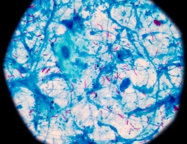 New Hope Against Drug-Resistant Tuberculosis