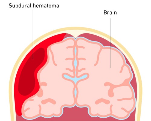 Subdural haematoma CT