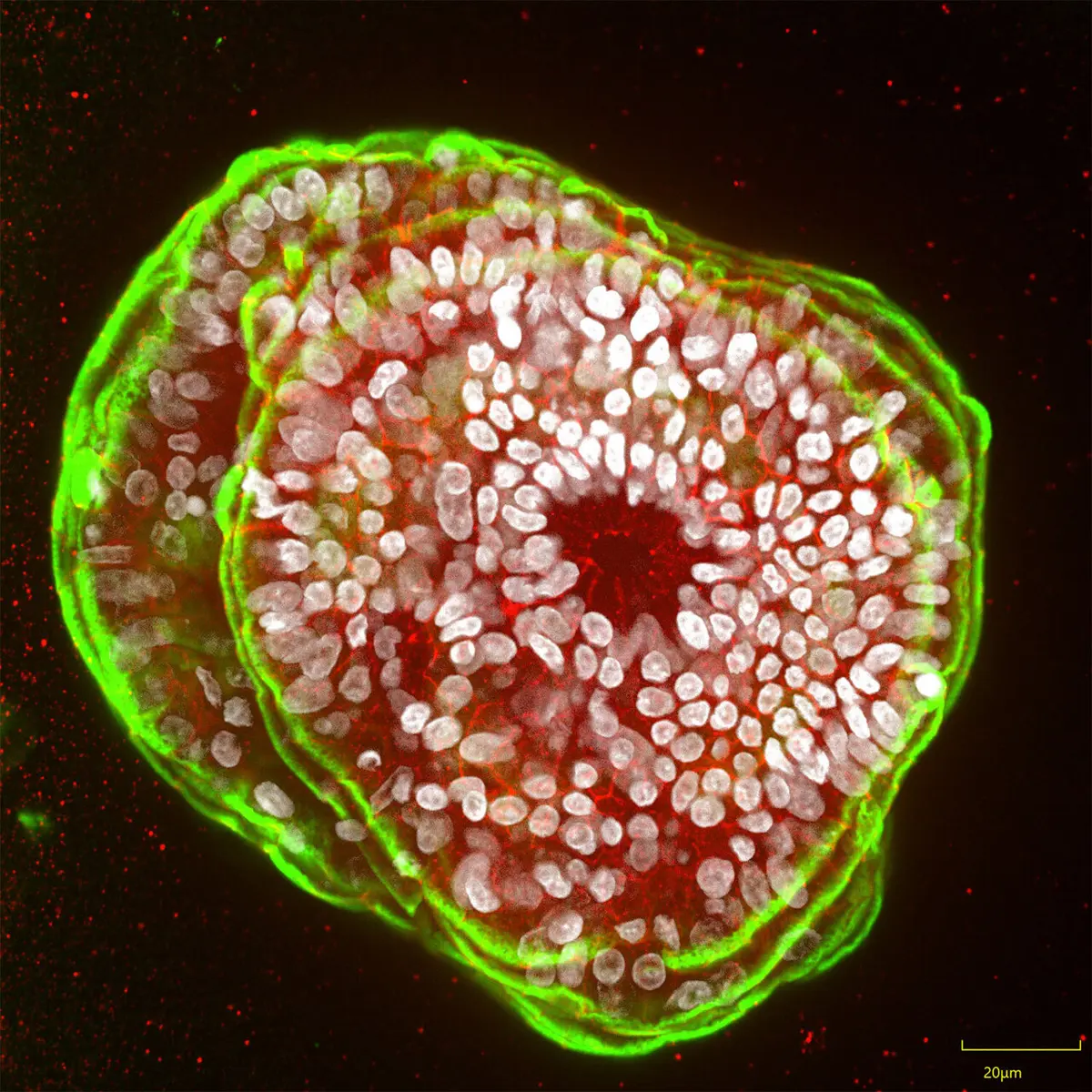 Personalized disease-in-a-dish can improve a pancreatitis patient's therapeutic path