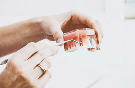 Sydney Dental Implants Tooth-Implants-Sydney