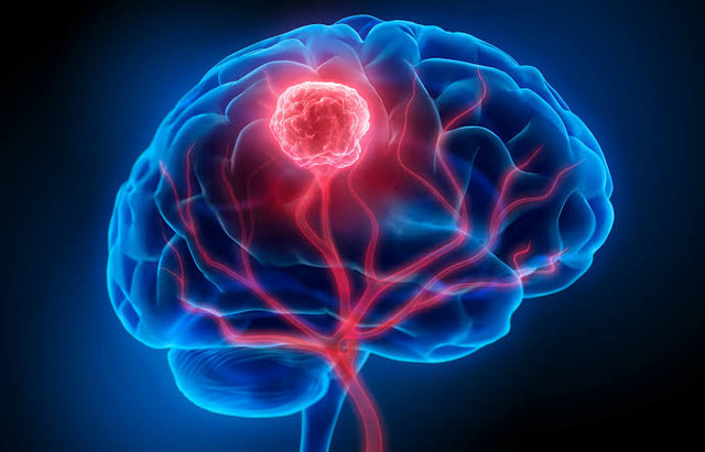 Brain Tumour