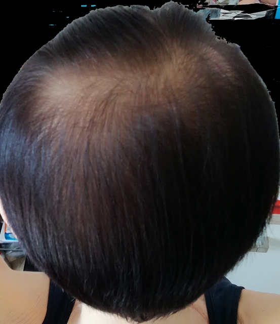 chute de cheveux femme vu du dessus