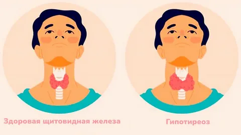 Гипотиреоз: когда щитовидная железа работает вполсилы