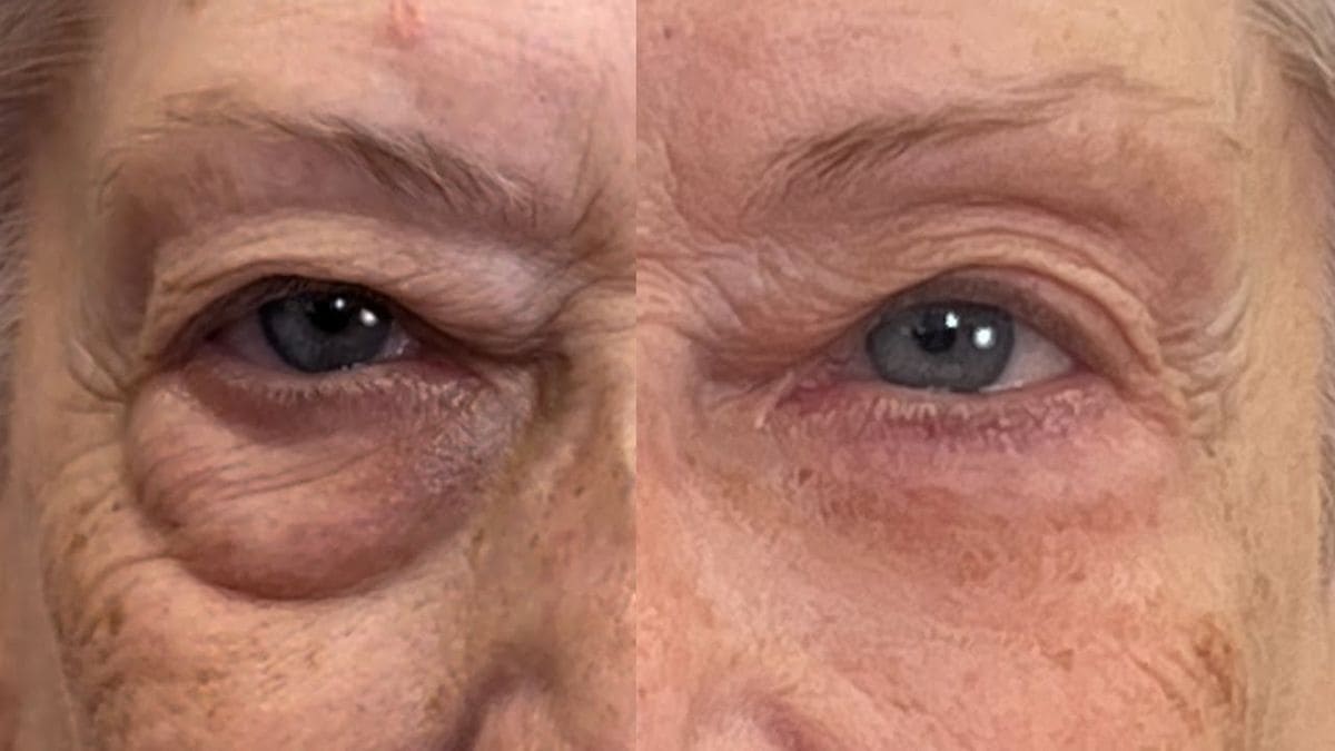 Bolsas y ojeras