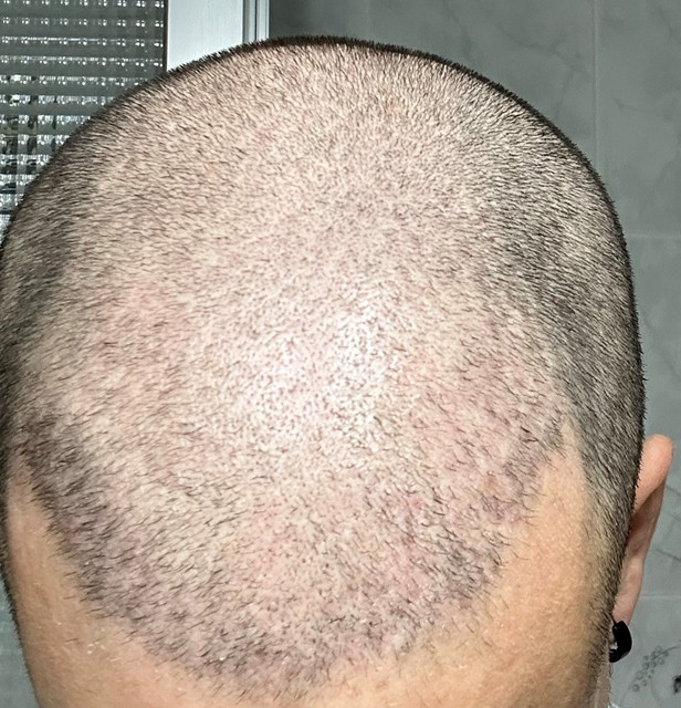 6-MESES-POST-TRASPLANTE-RAPADA