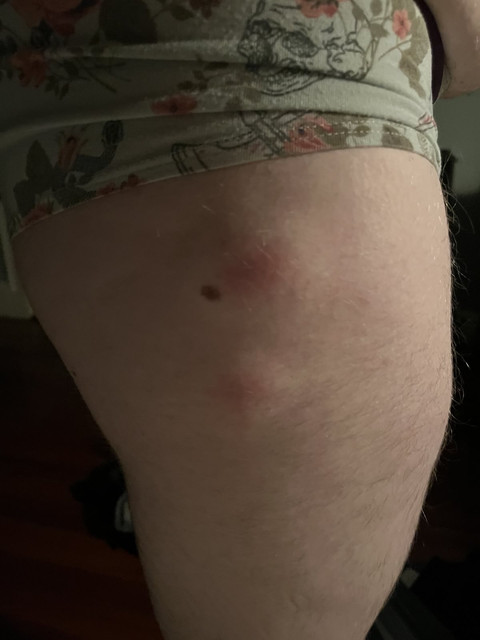 rash2.jpg
